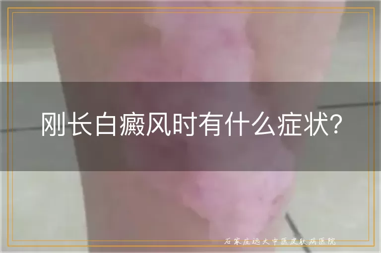 刚长白癜风时有什么症状？