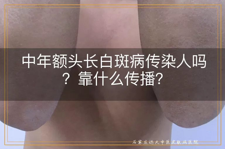 中年额头长白斑病传染人吗？靠什么传播？