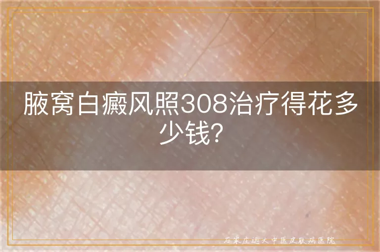 腋窝白癜风照308治疗得花多少钱？