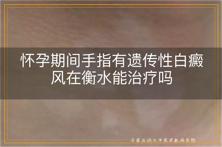 怀孕期间手指有遗传性白癜风在衡水能治疗吗