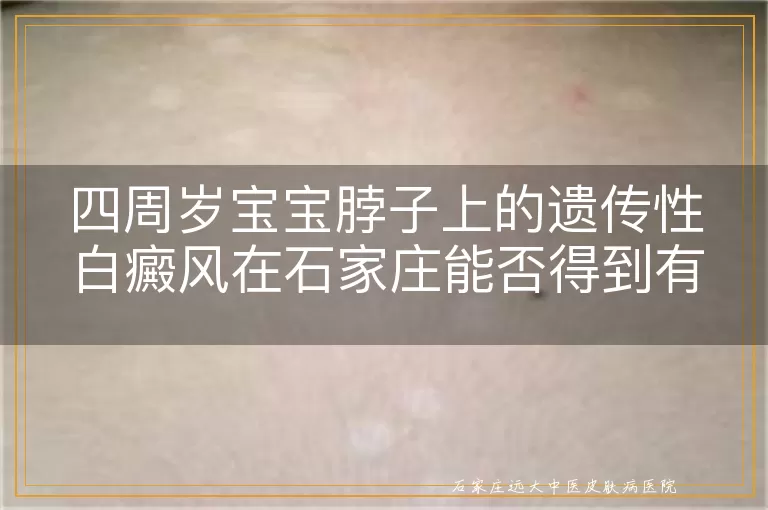 四周岁宝宝脖子上的遗传性白癜风在石家庄能否得到有效治疗？