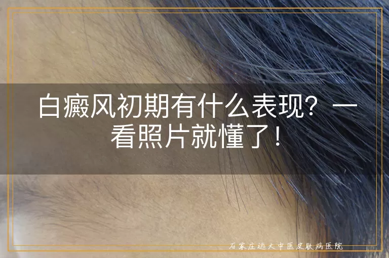 白癜风初期有什么表现？一看照片就懂了！