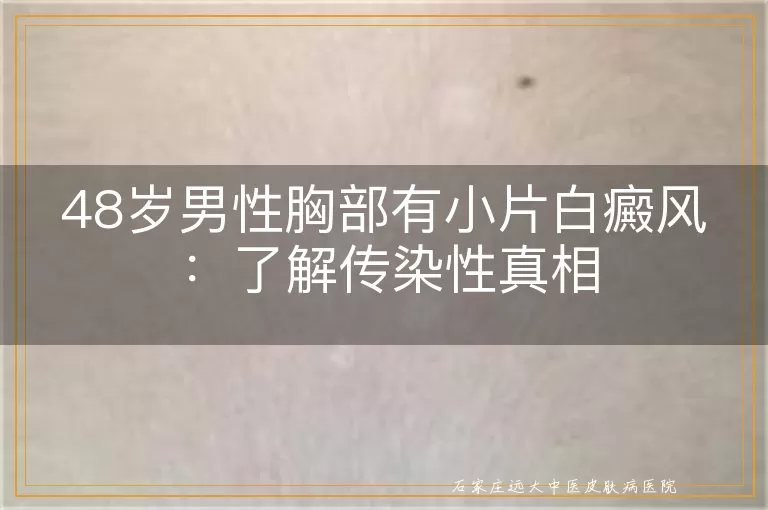 48岁男性胸部有小片白癜风：了解传染性真相
