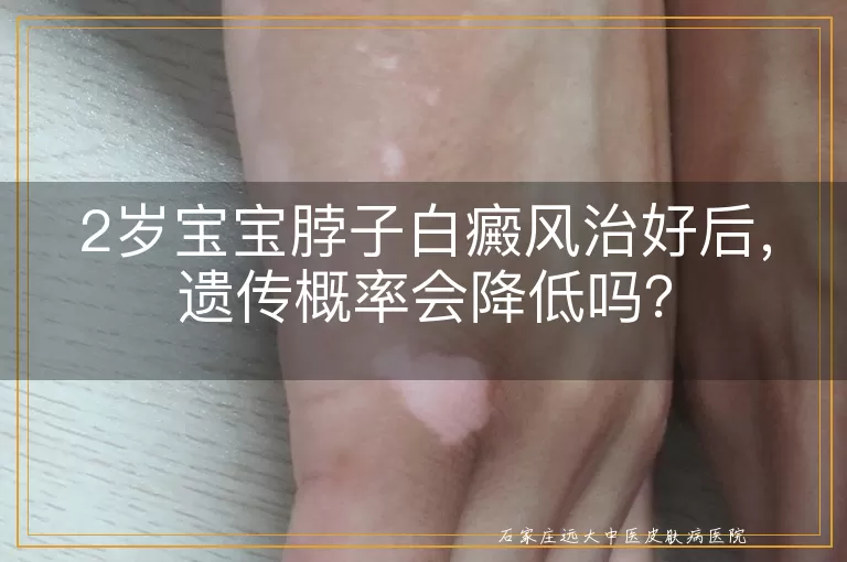 2岁宝宝脖子白癜风治好后，遗传概率会降低吗？