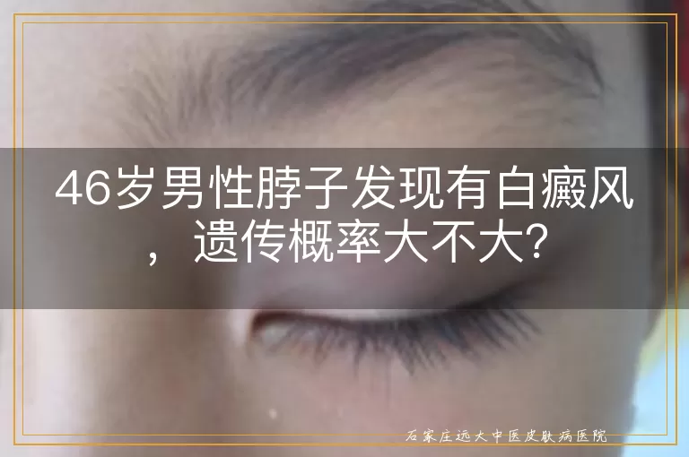 46岁男性脖子发现有白癜风，遗传概率大不大？