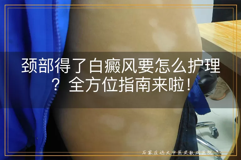 颈部得了白癜风要怎么护理？全方位指南来啦！
