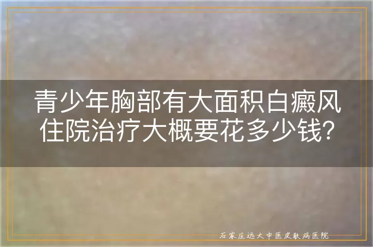 青少年胸部有大面积白癜风住院治疗大概要花多少钱？