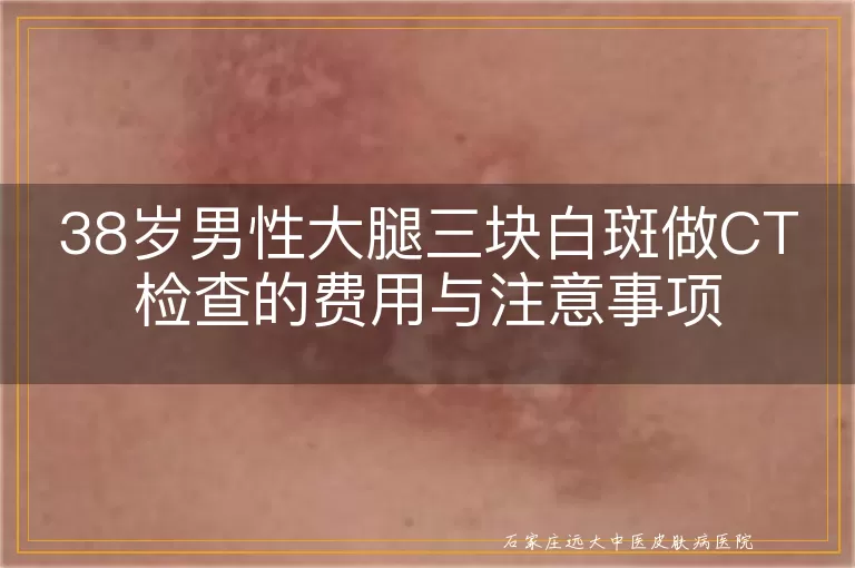 38岁男性大腿三块白斑做CT检查的费用与注意事项