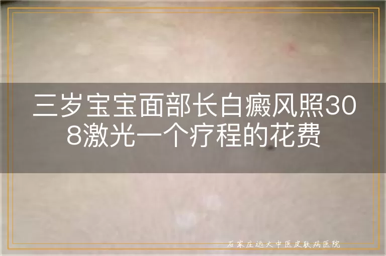 三岁宝宝面部长白癜风照308激光一个疗程的花费