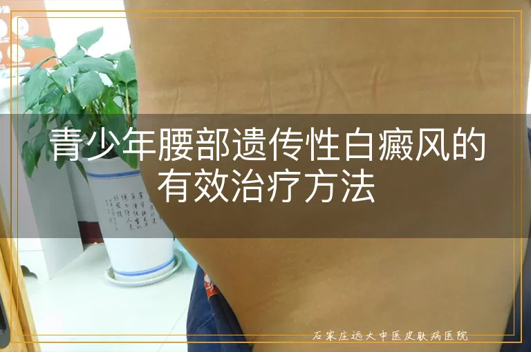 青少年腰部遗传性白癜风的有效治疗方法