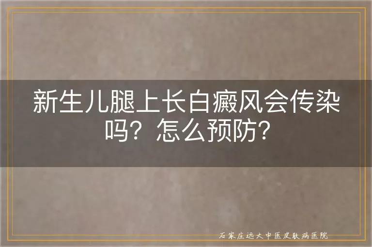 新生儿腿上长白癜风会传染吗？怎么预防？
