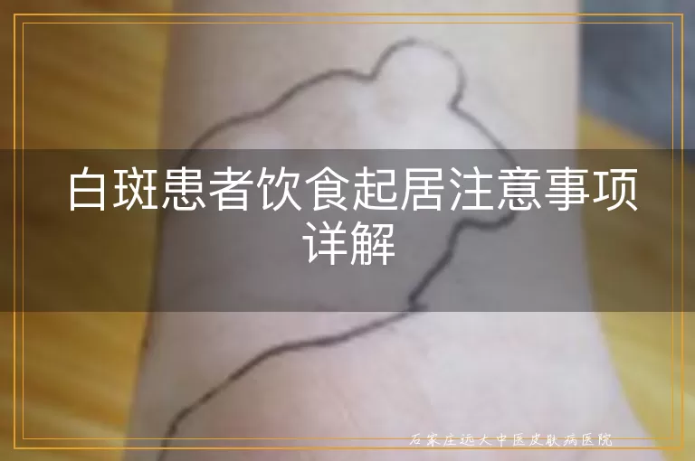 白斑患者饮食起居注意事项详解