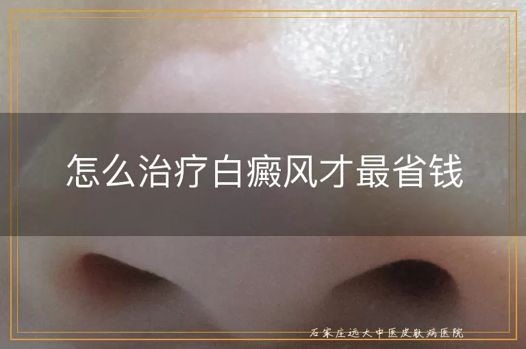 怎么治疗白癜风才最省钱