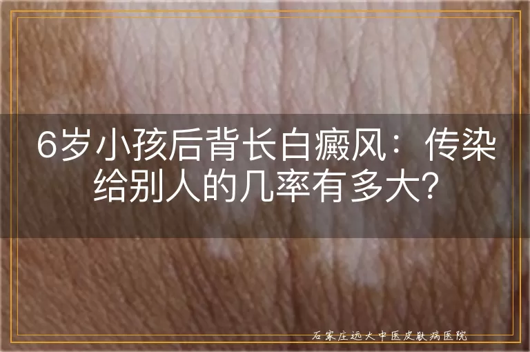 6岁小孩后背长白癜风：传染给别人的几率有多大？