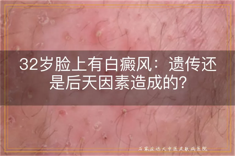 32岁脸上有白癜风：遗传还是后天因素造成的？