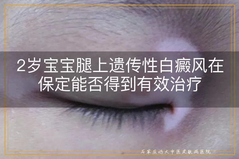 2岁宝宝腿上遗传性白癜风在保定能否得到有效治疗