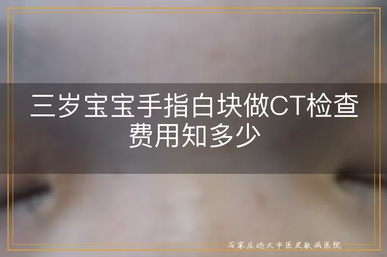 三岁宝宝手指白块做CT检查费用知多少