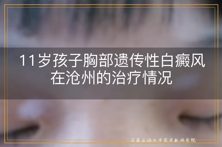 11岁孩子胸部遗传性白癜风在沧州的治疗情况