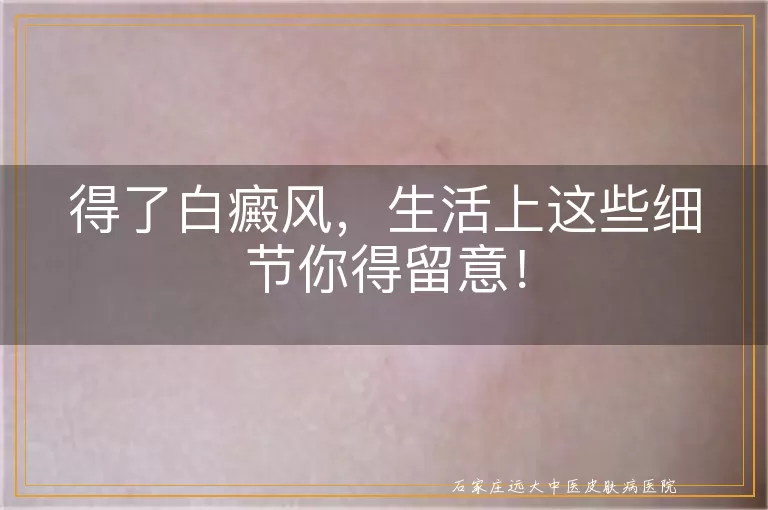 得了白癜风，生活上这些细节你得留意！