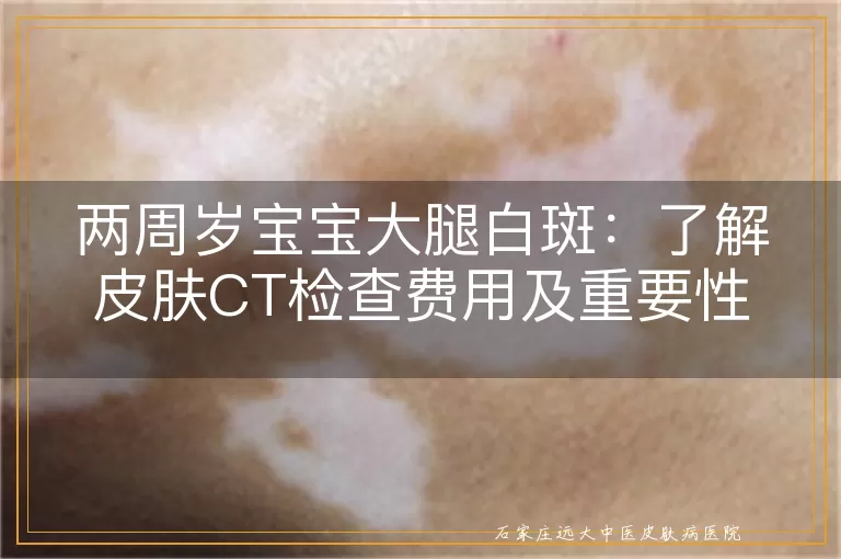 两周岁宝宝大腿白斑：了解皮肤CT检查费用及重要性