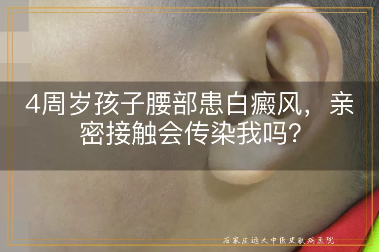 4周岁孩子腰部患白癜风，亲密接触会传染我吗？
