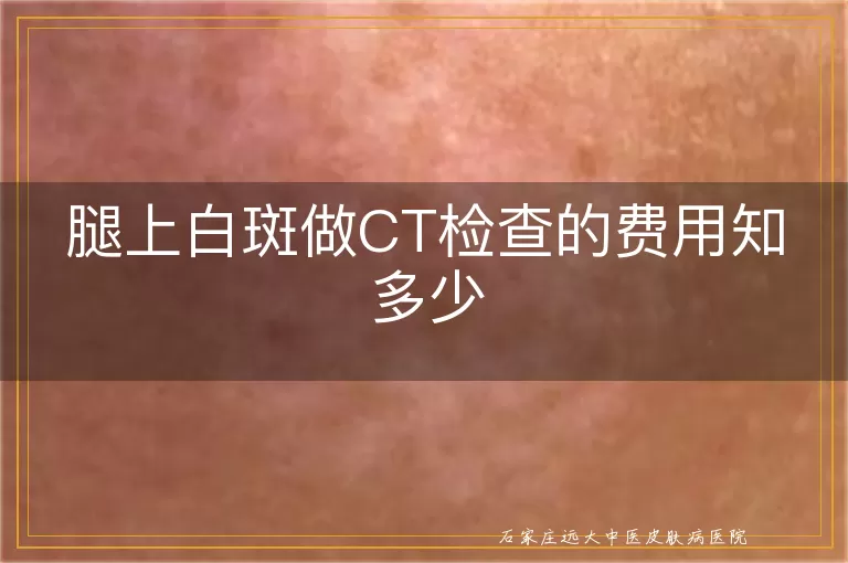 腿上白斑做CT检查的费用知多少