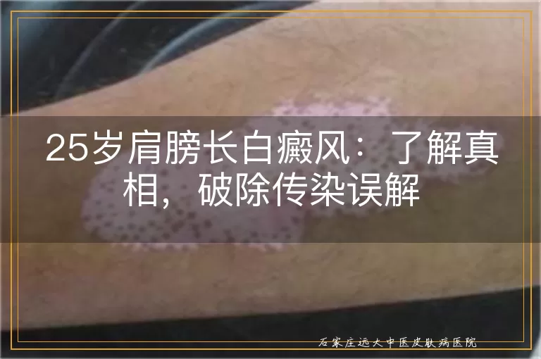 25岁肩膀长白癜风：了解真相，破除传染误解