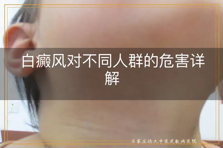 白癜风对不同人群的危害详解