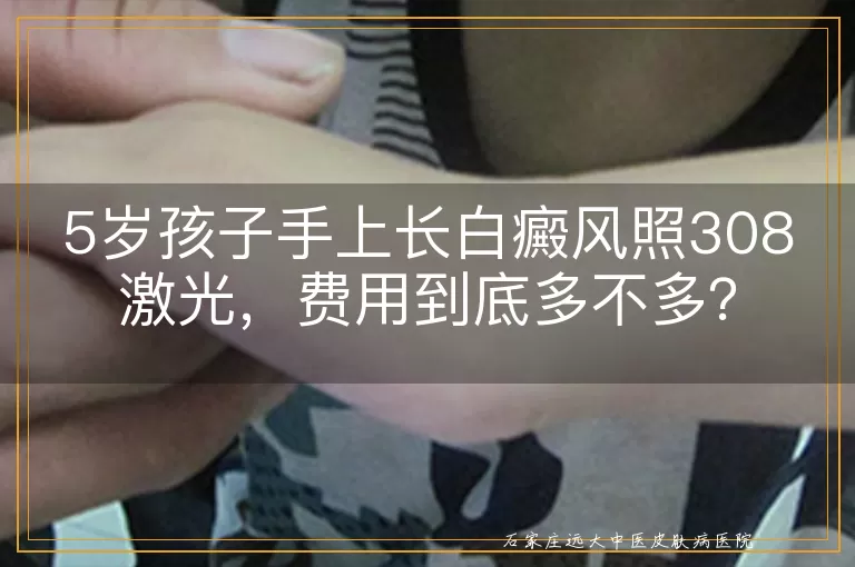 5岁孩子手上长白癜风照308激光，费用到底多不多？
