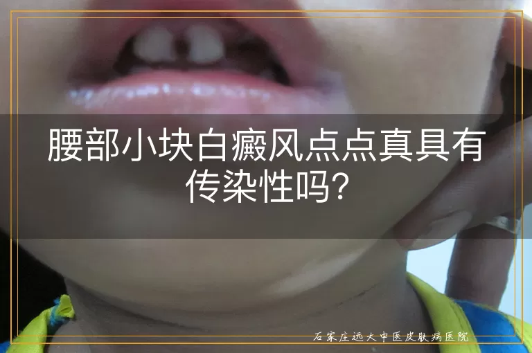 腰部小块白癜风点点真具有传染性吗？