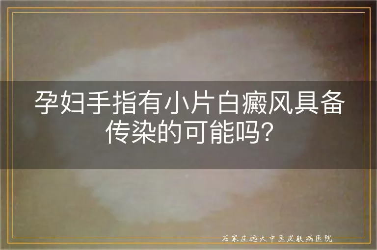 孕妇手指有小片白癜风具备传染的可能吗？
