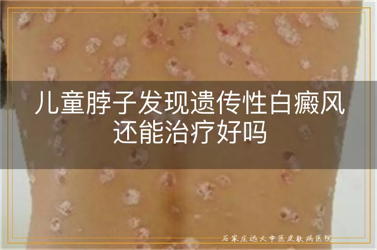 儿童脖子发现遗传性白癜风还能治疗好吗