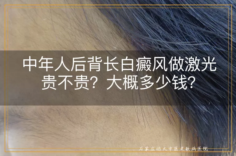 中年人后背长白癜风做激光贵不贵？大概多少钱？