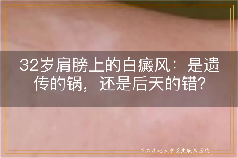 32岁肩膀上的白癜风：是遗传的锅，还是后天的错？