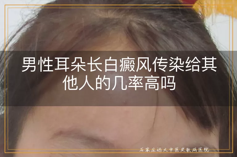 男性耳朵长白癜风传染给其他人的几率高吗