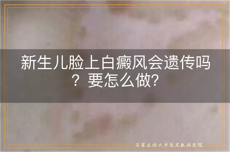 新生儿脸上白癜风会遗传吗？要怎么做？