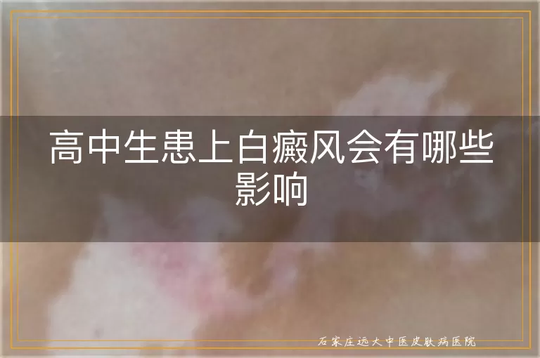 高中生患上白癜风会有哪些影响