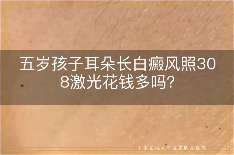 五岁孩子耳朵长白癜风照308激光花钱多吗？