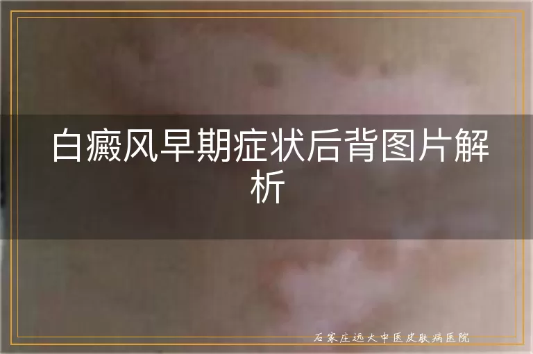 白癜风早期症状后背图片解析