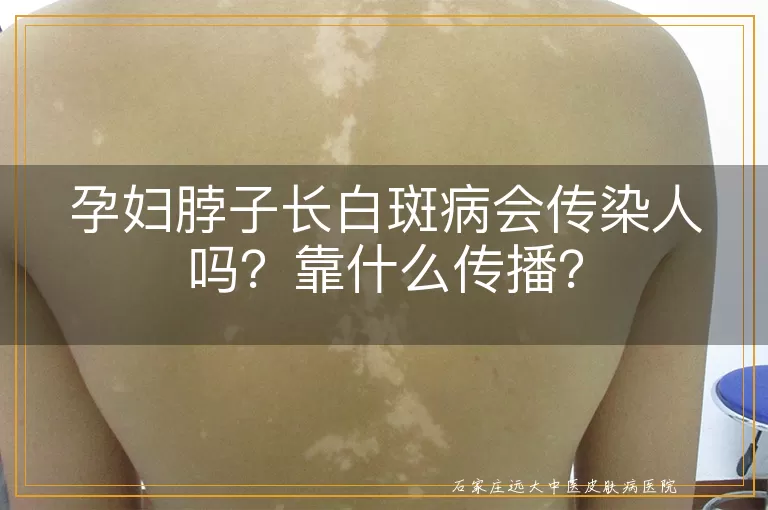 孕妇脖子长白斑病会传染人吗？靠什么传播？