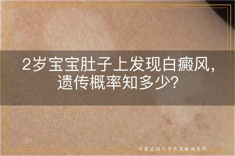 2岁宝宝肚子上发现白癜风，遗传概率知多少？