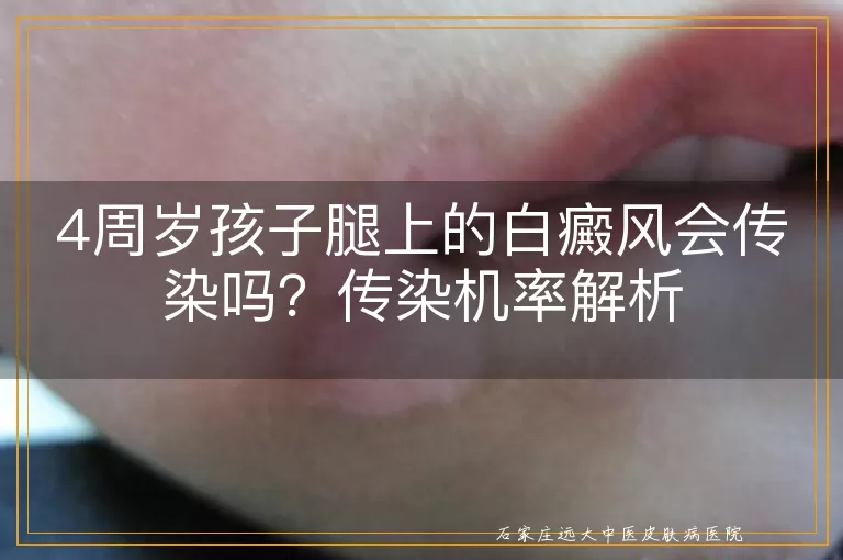 4周岁孩子腿上的白癜风会传染吗？传染机率解析