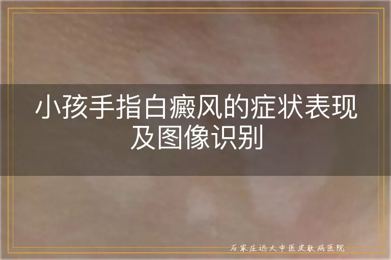 小孩手指白癜风的症状表现及图像识别