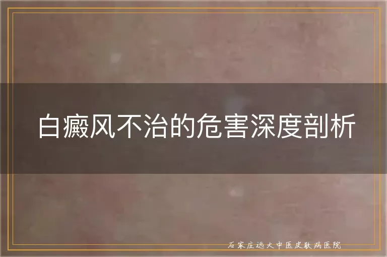 白癜风不治的危害深度剖析