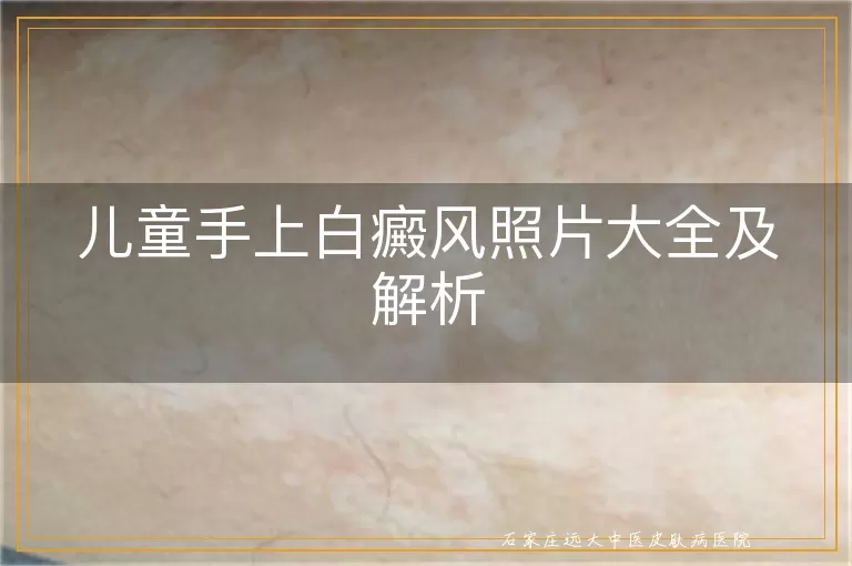 儿童手上白癜风照片大全及解析