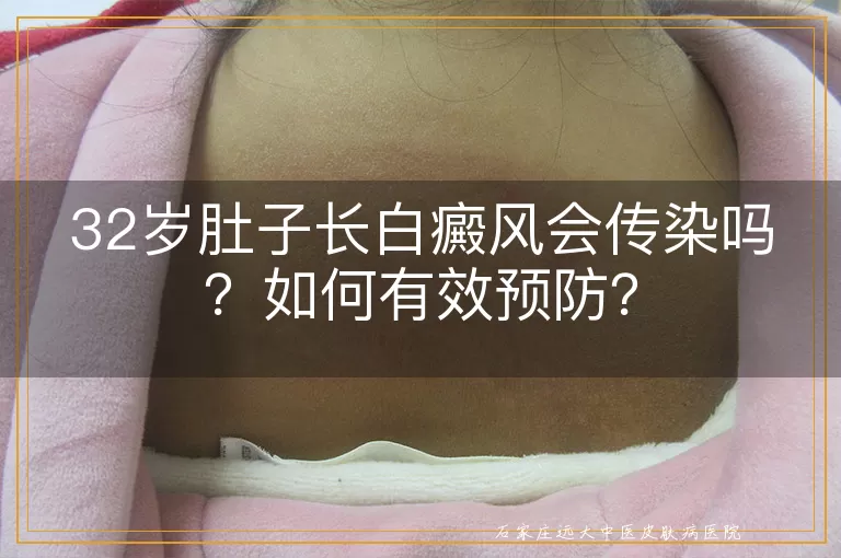 32岁肚子长白癜风会传染吗？如何有效预防？