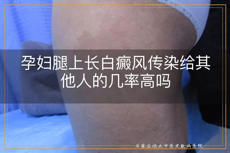孕妇腿上长白癜风传染给其他人的几率高吗