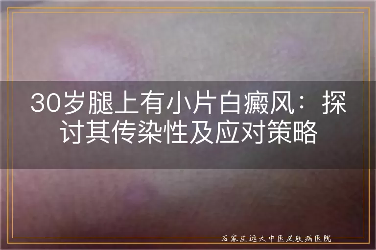 30岁腿上有小片白癜风：探讨其传染性及应对策略