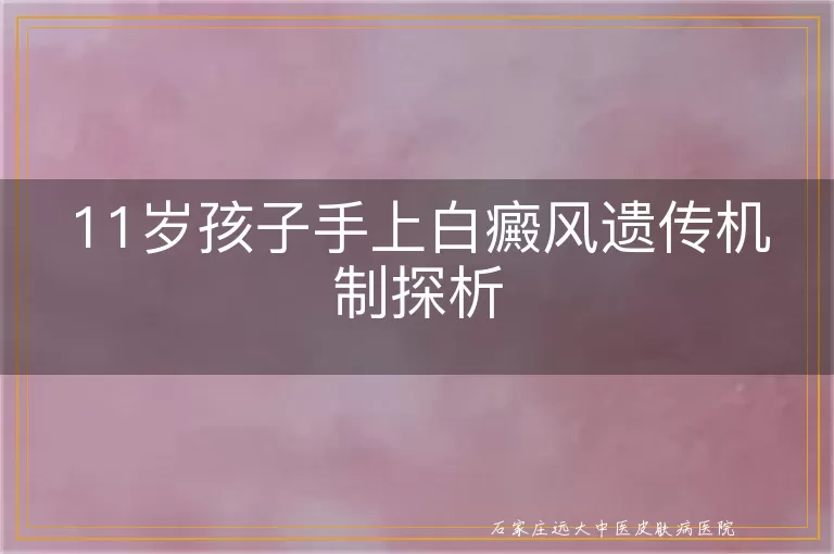 11岁孩子手上白癜风遗传机制探析