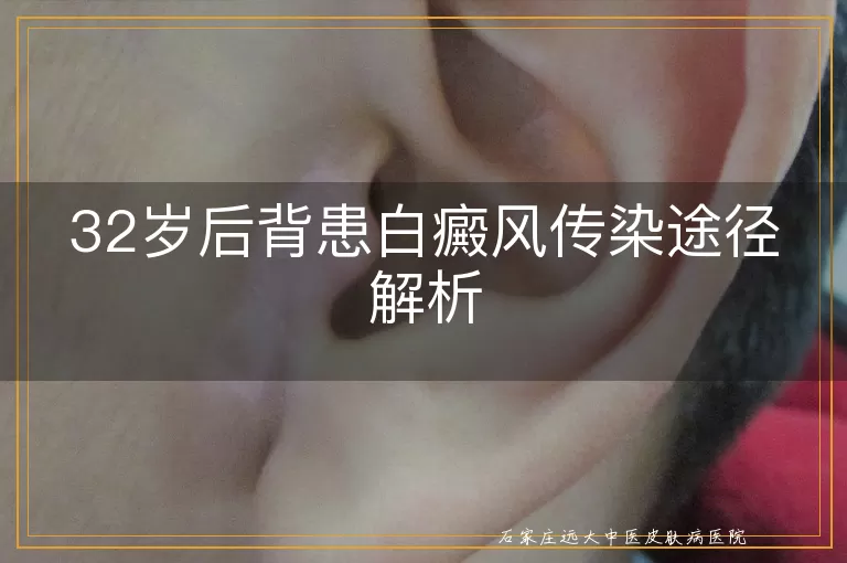 32岁后背患白癜风传染途径解析